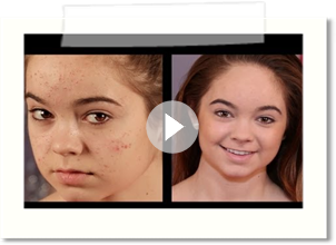 Acne Coverage Foundation Routine!