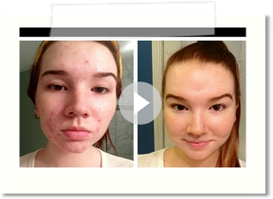 How I Cleared My Acne (+ Before & After Pictures)